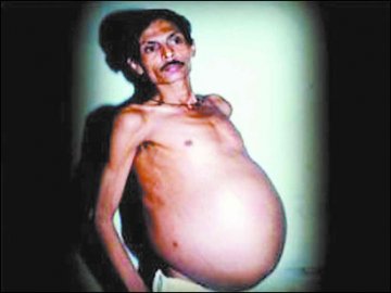 印度男子怀胎孪生兄弟36年