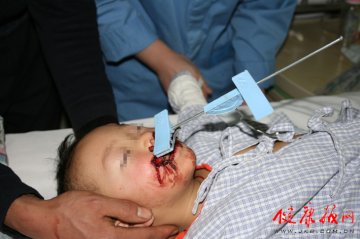 北京儿童医院成功救治衣裤架险些戳穿颅底的1岁幼童