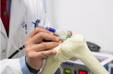 澳研制出能直接在病人体内3D打印骨骼的生物笔