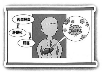 丙型肝炎认知度低漏报率高