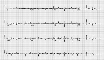 陈旧下壁心肌梗塞Old inferior myocardial infarctiona