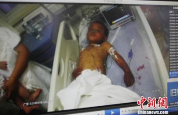 河北6岁男童遭继母施暴 双手被吊长达3小时坏死