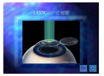 lasik13