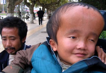 全球最恐怖的67种怪病