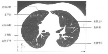 正常胸部肺窗CT（7）