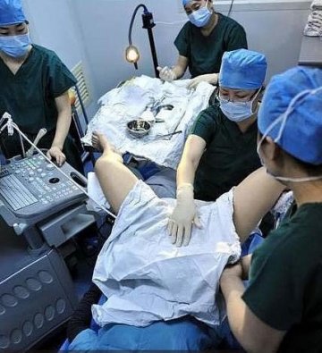 实拍试管婴儿取卵抽精过程