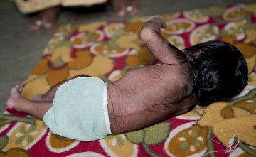 印度惊现“狼孩”