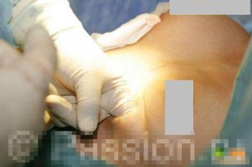 实拍国外隆胸手术全程