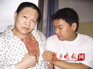 儿子三次割头皮给重度烫伤父亲植皮