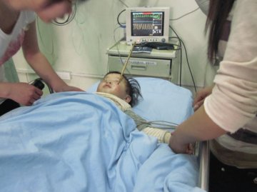 吃饭时不慎跌倒 筷子插进女童脸颊4厘米深