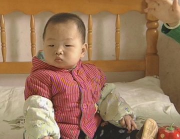 医院未进行眼部检查 早产儿吸氧致双目失明