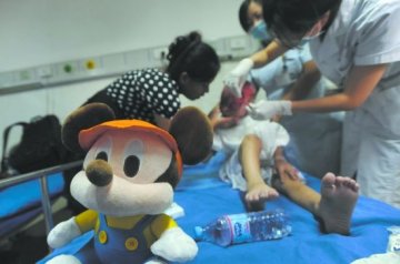男童遭毁容没有头皮和耳朵 母亲坚持治疗不放弃