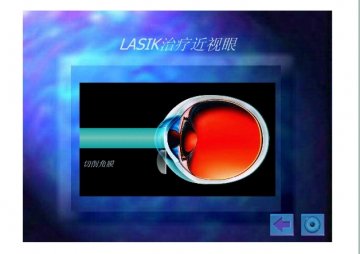 lasik3
