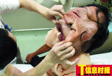 男子脸部长硕大肉瘤 五官难辨呼吸进食困难