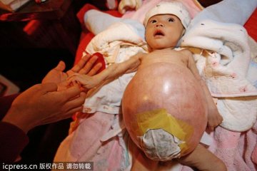 5个月男婴得怪病肚如气球