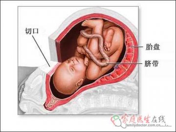 医学图解：剖腹产手术全过程