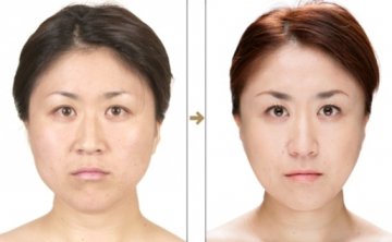 日本整形医院惊悚整容对比照大曝光