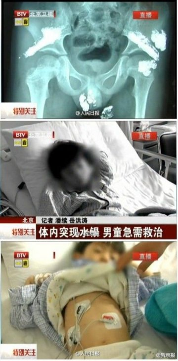 昆明一男童体内疑被灌大量汞 臀部挤出水银珠