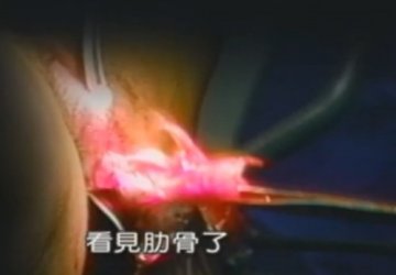 实拍：美国堕胎手术全过程