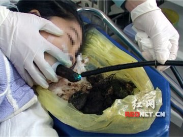 七岁女童患异食癖 四年吞食头发一斤多