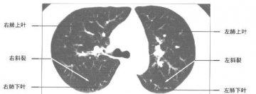 正常胸部肺窗CT（6）