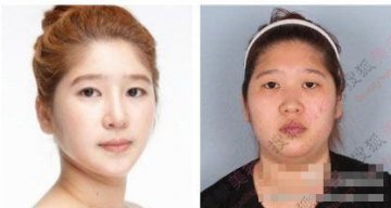 31个惊人韩国整容案例