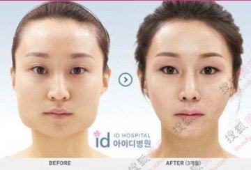 31个惊人韩国整容案例