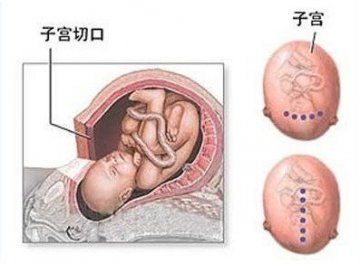 医学实录：女性剖腹产手术全过程