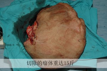 世界罕见巨大面部神经纤维瘤在第四军医大学口腔医学院成功切除