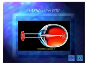 lasik7