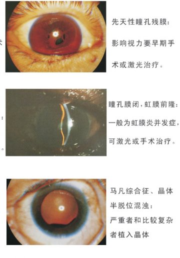 先天性瞳孔残膜、瞳孔膜闭，虹膜前隆、马凡综合症、警惕半脱位混浊