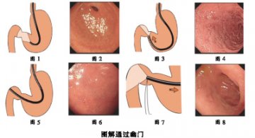 胃肠交接：幽门是关键