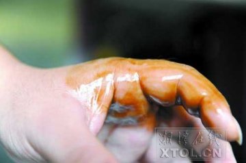 住酒店被毒虫叮咬 男子食指肿胀无法弯曲