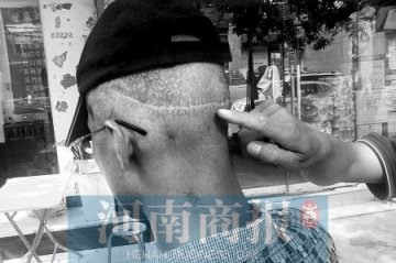 男子投诉植发效果不理想 医生称总比秃子强