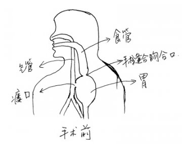 裙式支架堵胃瘘