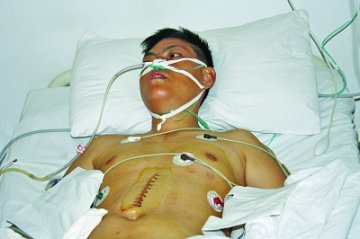 男子吞下22颗铁钉后求救 自称被养父母虐待