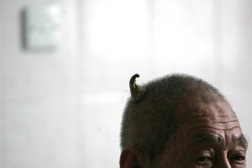 八旬老人的头上长出犄角