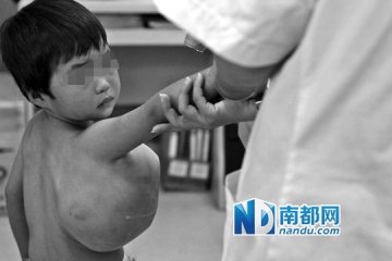 三岁娃腋下长出足球大血管瘤 疑与滥用激素有关