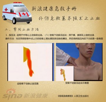 指压止血方法：锁骨下动脉压迫法