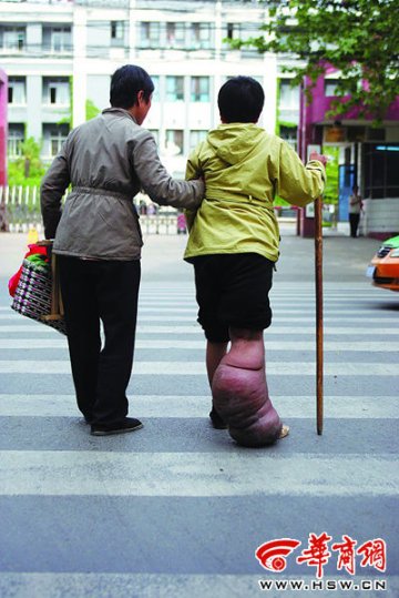 女子右腿是左腿4倍粗 行走靠拐杖还要搀扶
