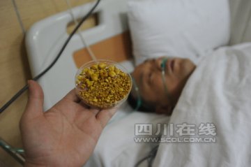 一个胆囊1300颗结石 饮食不规律惹的祸