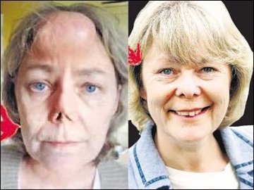 英女子鼻子被狗咬掉移植肋骨造出新的