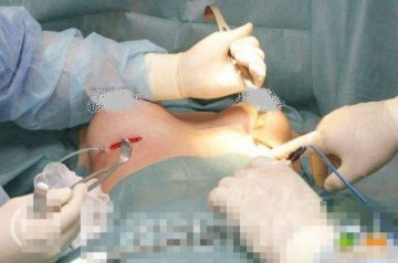 实拍国外隆胸手术全程
