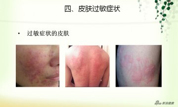 皮肤过敏