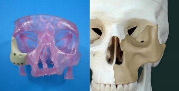 3D打印物“面部植入”手术通过FDA审批