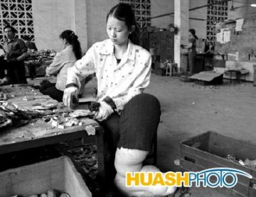 19岁少女患怪病左腿粗如树干