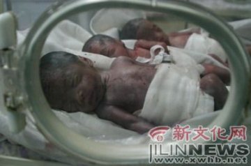 长春市29岁孕妇早产生下五胞胎