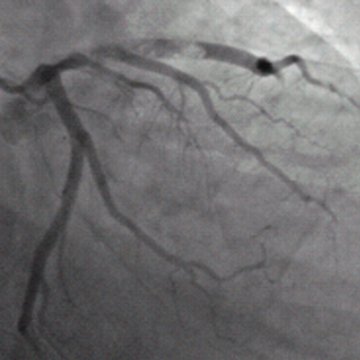 AMI患者充分抗栓后的PCI