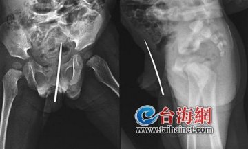 两岁男童一屁股坐下7厘米针头 下体受伤
