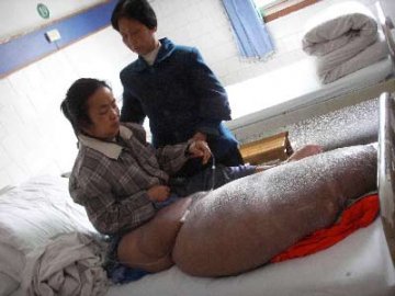 男子右腿18年来不断变粗重达70公斤